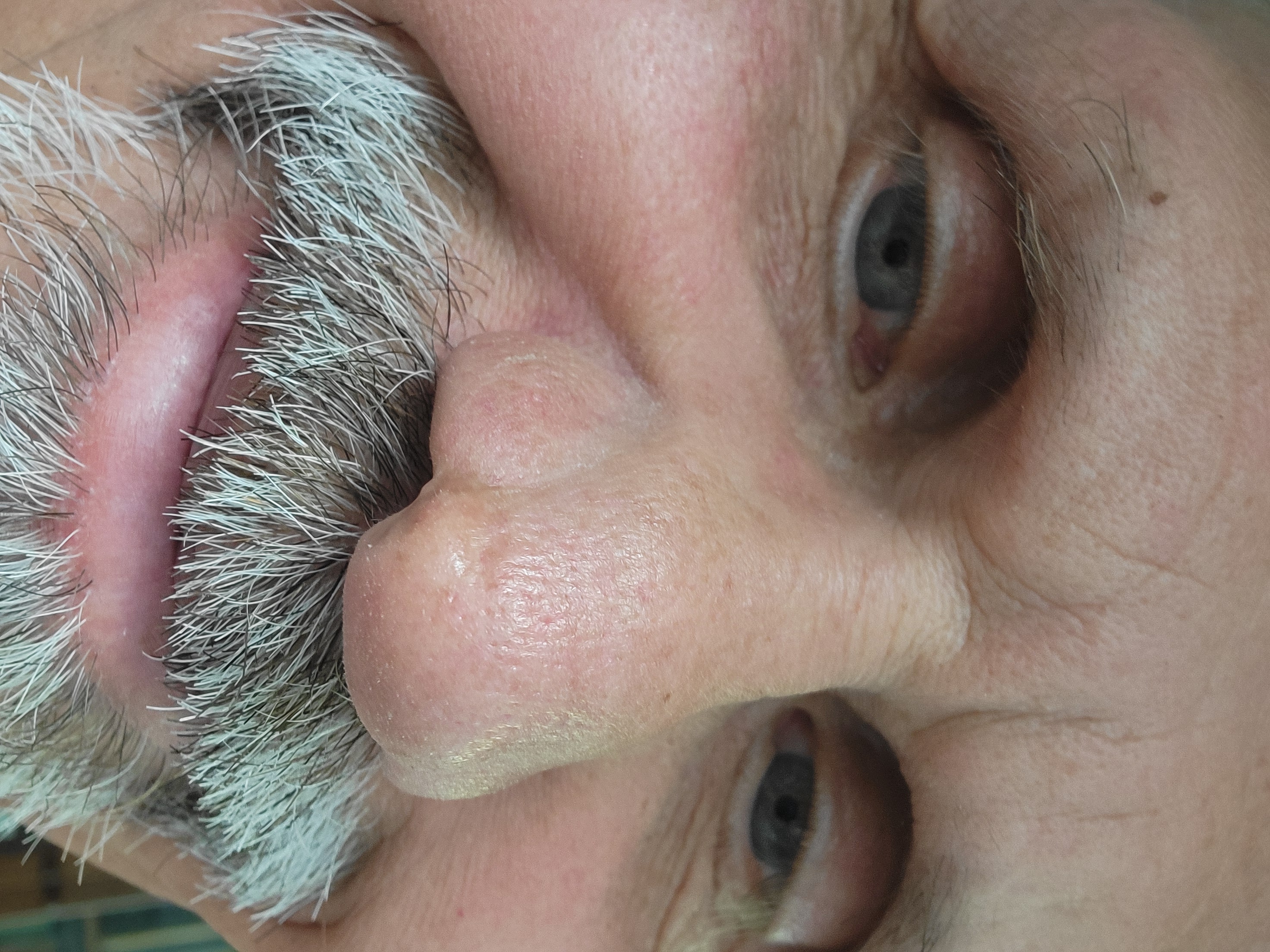 Russ L'HommeDieu showing the nasal notch scar from his ICU experience